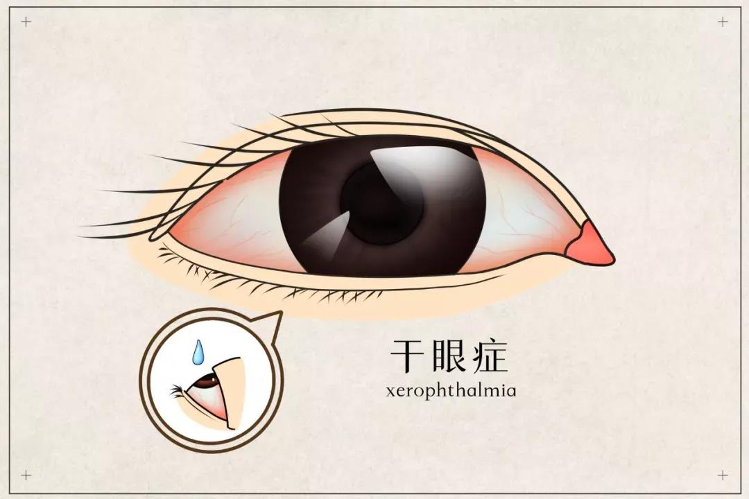 干眼患者福音來(lái)啦！(圖2)